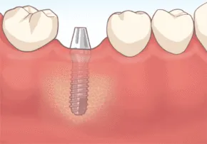 STEP5:アバットメントの装着(二次手術)